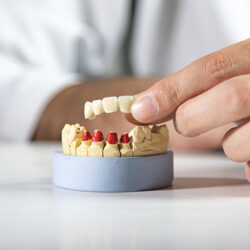 Puente en un implante dental