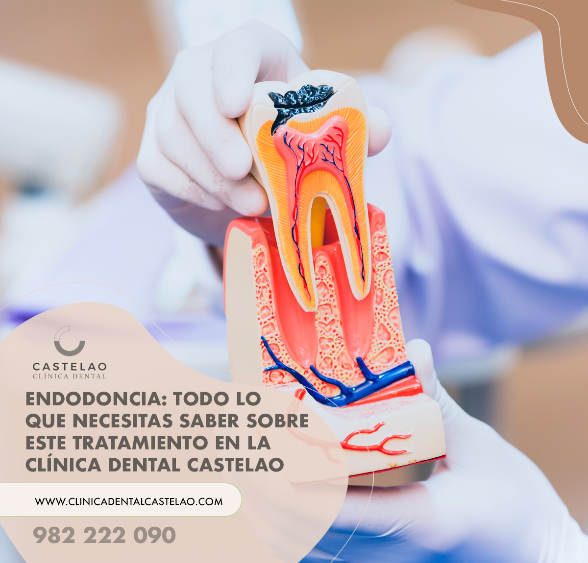 Tratamientos de endodoncia en Lugo